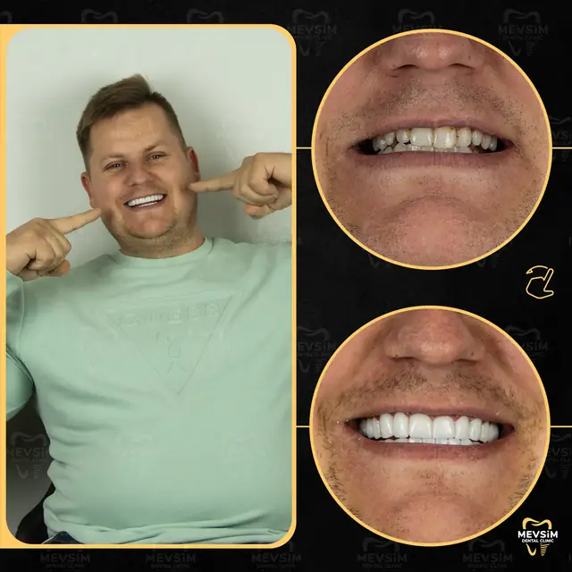 Patient 1: smile before and after treatment at Mevsim Dental Clinic