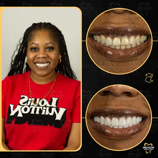 Patient 5: smile before and after treatment at Mevsim Dental Clinic