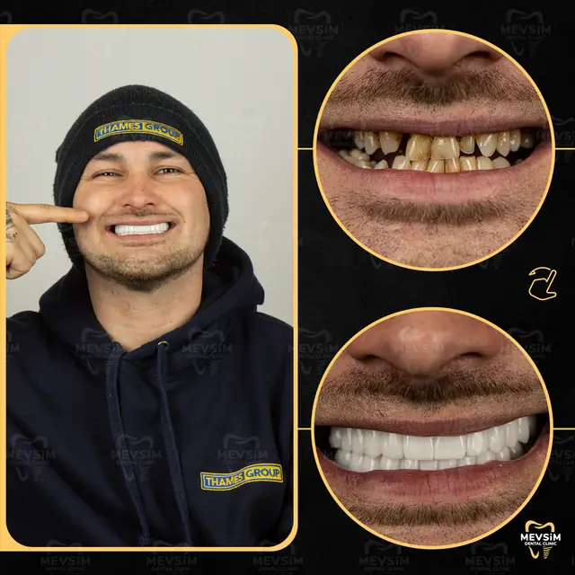 Patient 6: smile before and after treatment at Mevsim Dental Clinic