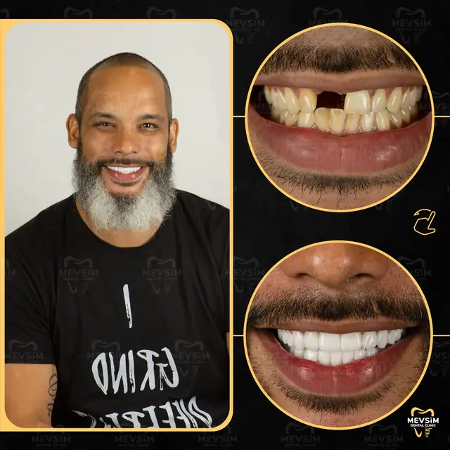 Patient 4: smile before and after treatment at Mevsim Dental Clinic