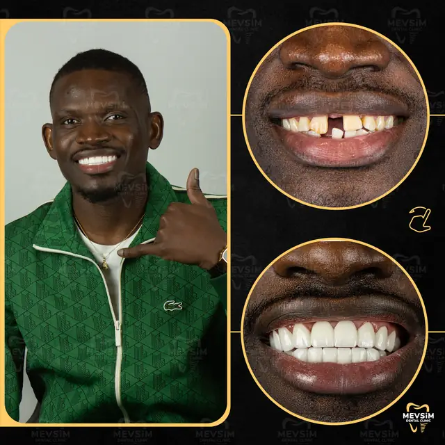 Patient 9: smile before and after treatment at Mevsim Dental Clinic