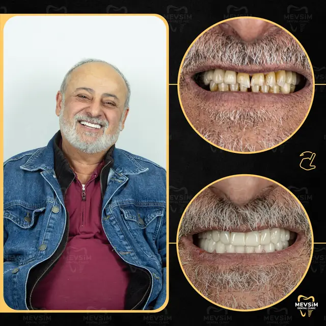 Patient 8: smile before and after treatment at Mevsim Dental Clinic