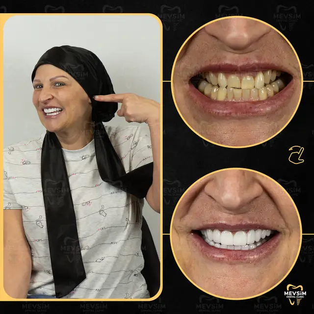 Patient 10: smile before and after treatment at Mevsim Dental Clinic